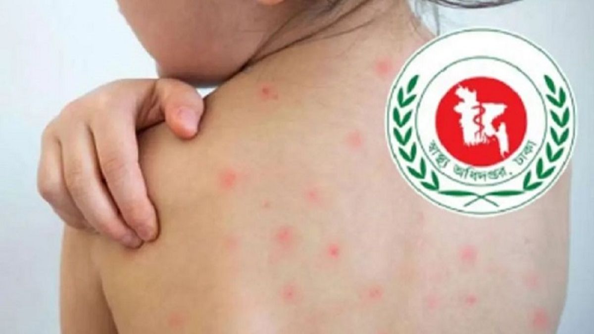 হামের উপসর্গে আরও ৪ শিশুর মৃত্যু