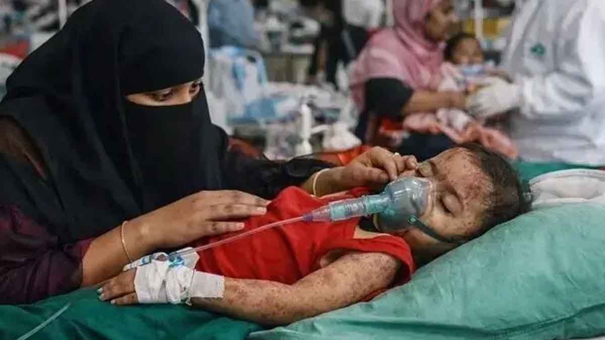 হামের উপসর্গে দেড় মাসে প্রাণ গেল ২৩৫ শিশুর