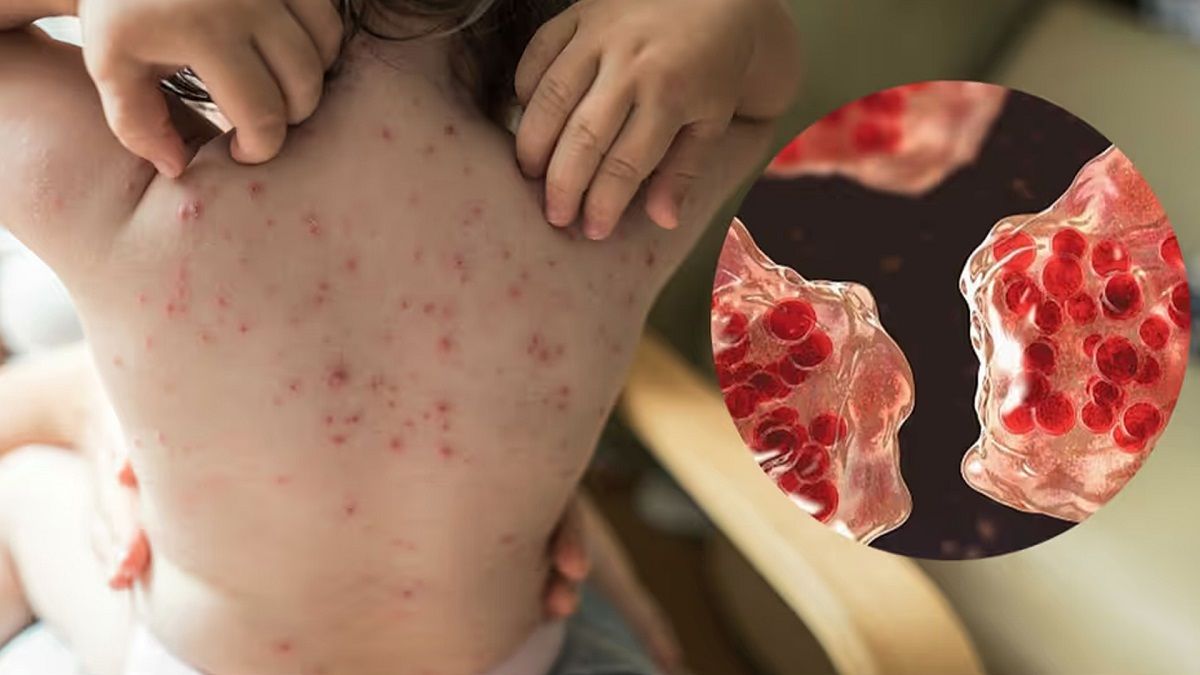 কীভাবে বুঝবেন সন্তানের হাম হয়েছে, জেনে নিন চিকিৎসকের পরামর্শ