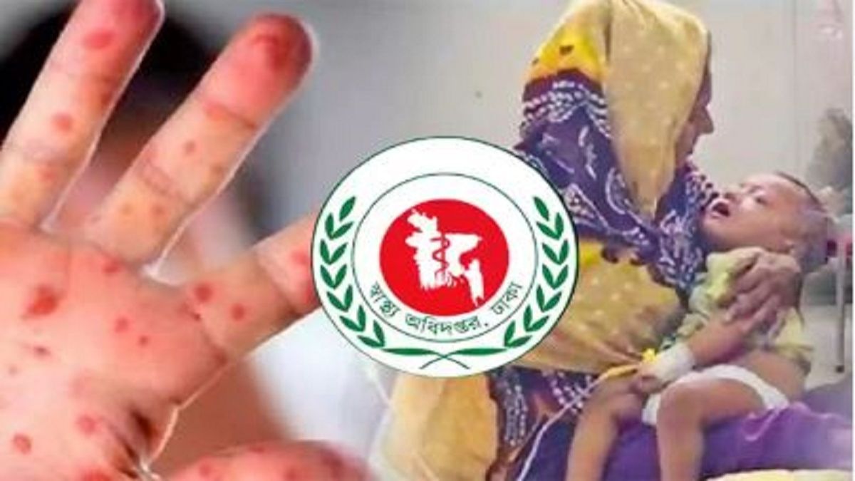হাম ও হামের উপসর্গে আরও ১১ শিশুর মৃত্যু, নতুন আক্রান্ত ১,৩৩৭