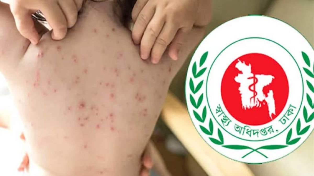 হামের উপসর্গে আরও ৫ শিশুর মৃত্যু