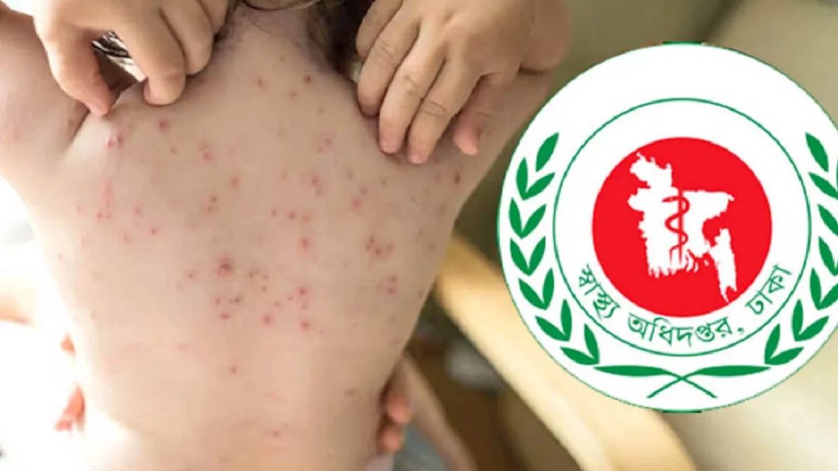 হামের উপসর্গে আরও ১ মৃত্যু, মোট ৬৫৭
