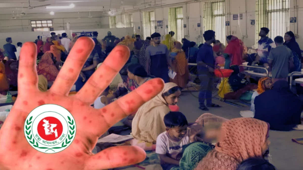 হামের উপসর্গে আরও ৫ শিশুর মৃত্যু